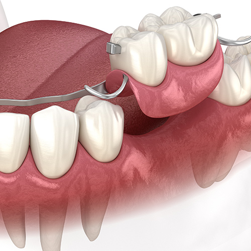 3D render of a removable partial denture