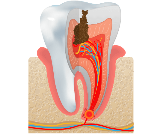 Tooth with cavity illustration