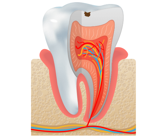 Tooth with cavity illustration