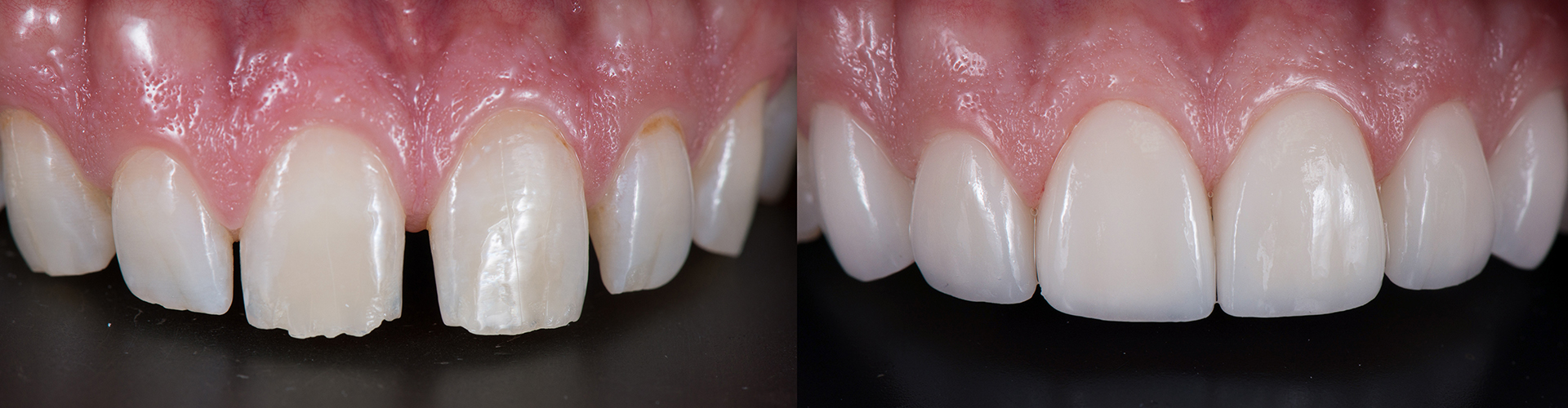 Before-and-after comparison of teeth without and with veneers.