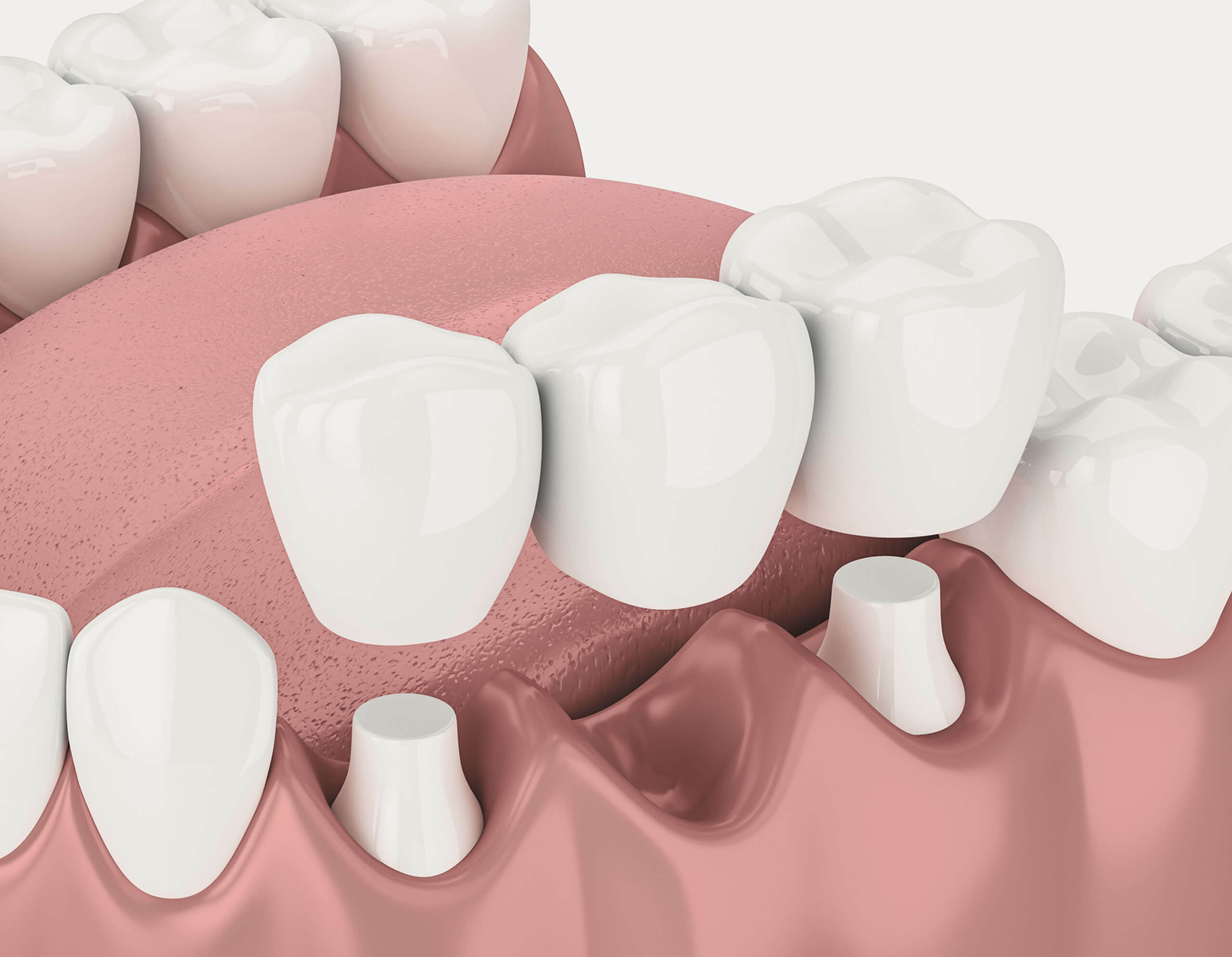 Image of a dental bridge