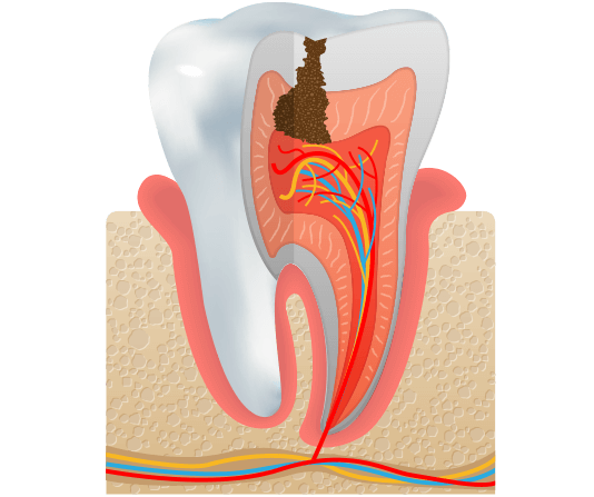 Tooth with cavity illustration